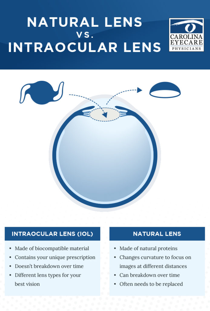 Natural Lens vs Intraocular Lens