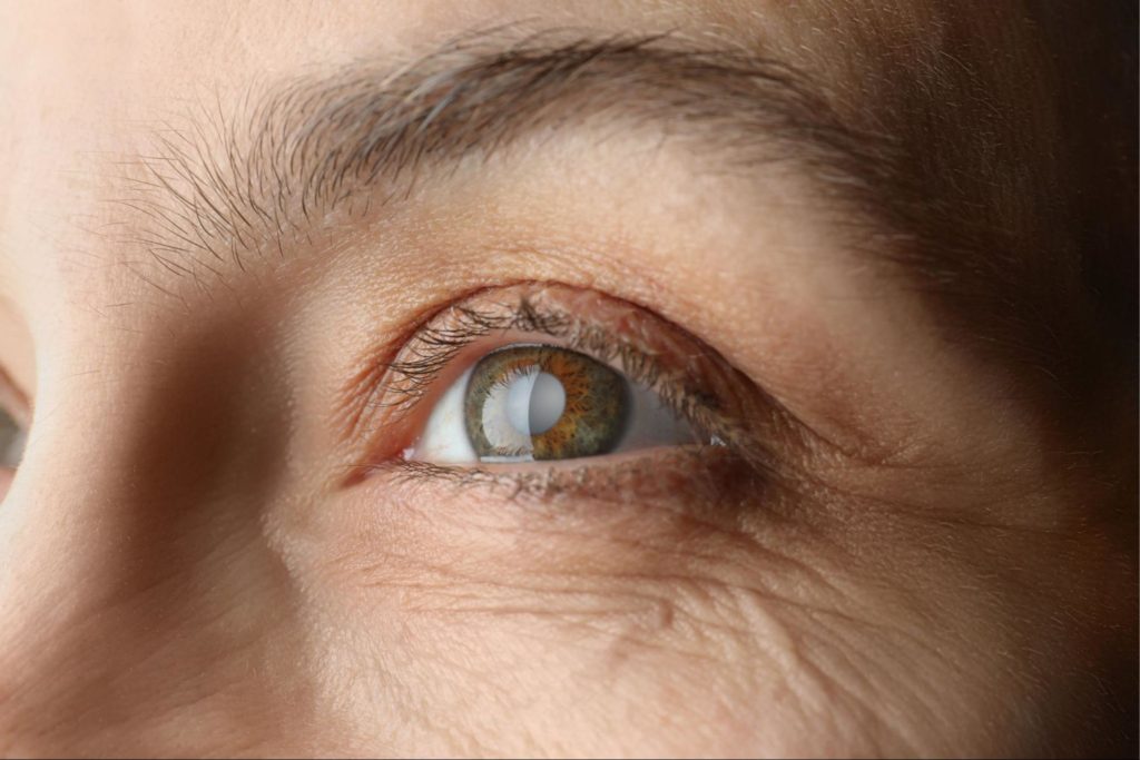 A close-up image of a woman's eye with a cataract