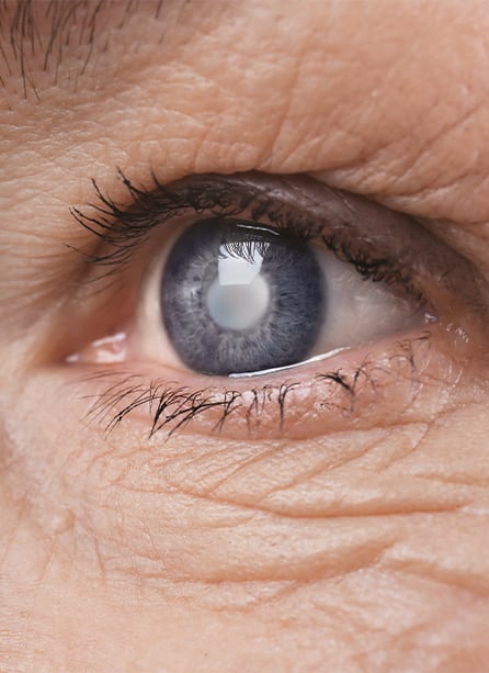 Clear Vision after Cataract Surgery