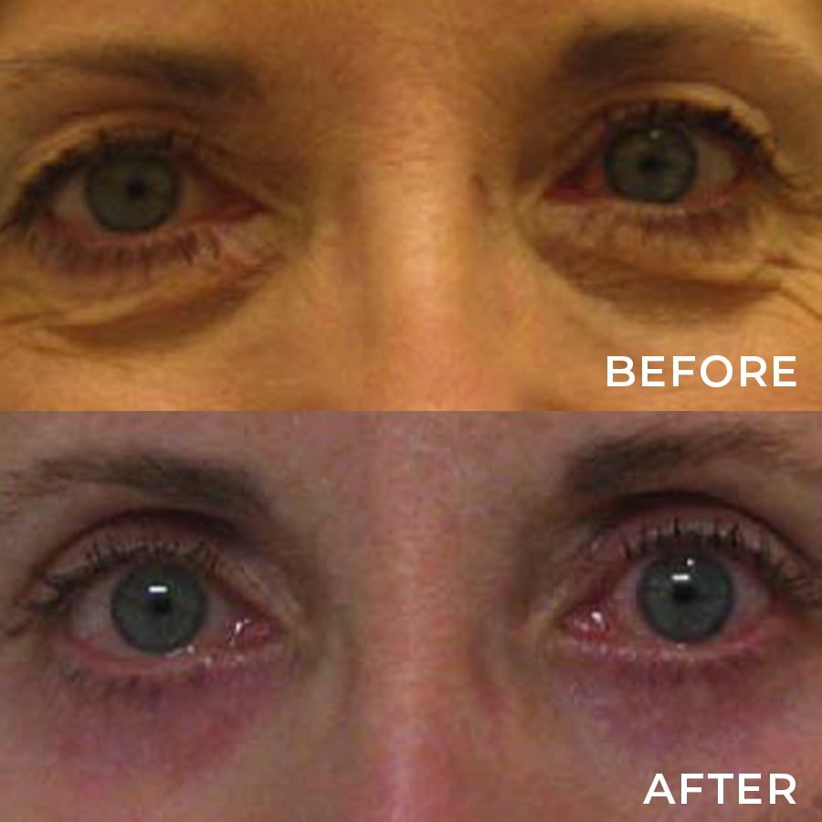 Upper Lid Blepharoplasty and Cosmetic Lower Lid Blepharoplasty with CO2 Both Eyes