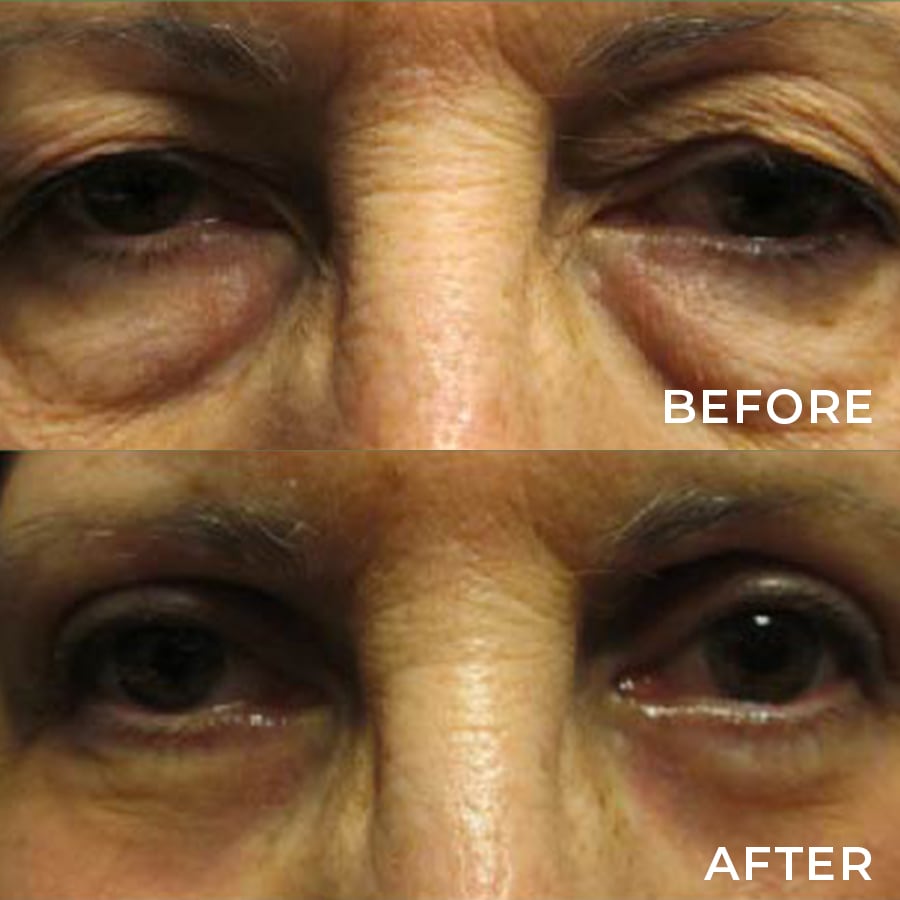 Upper Lid Blepharoplasty & Cosmetic Lower Lid Surgery