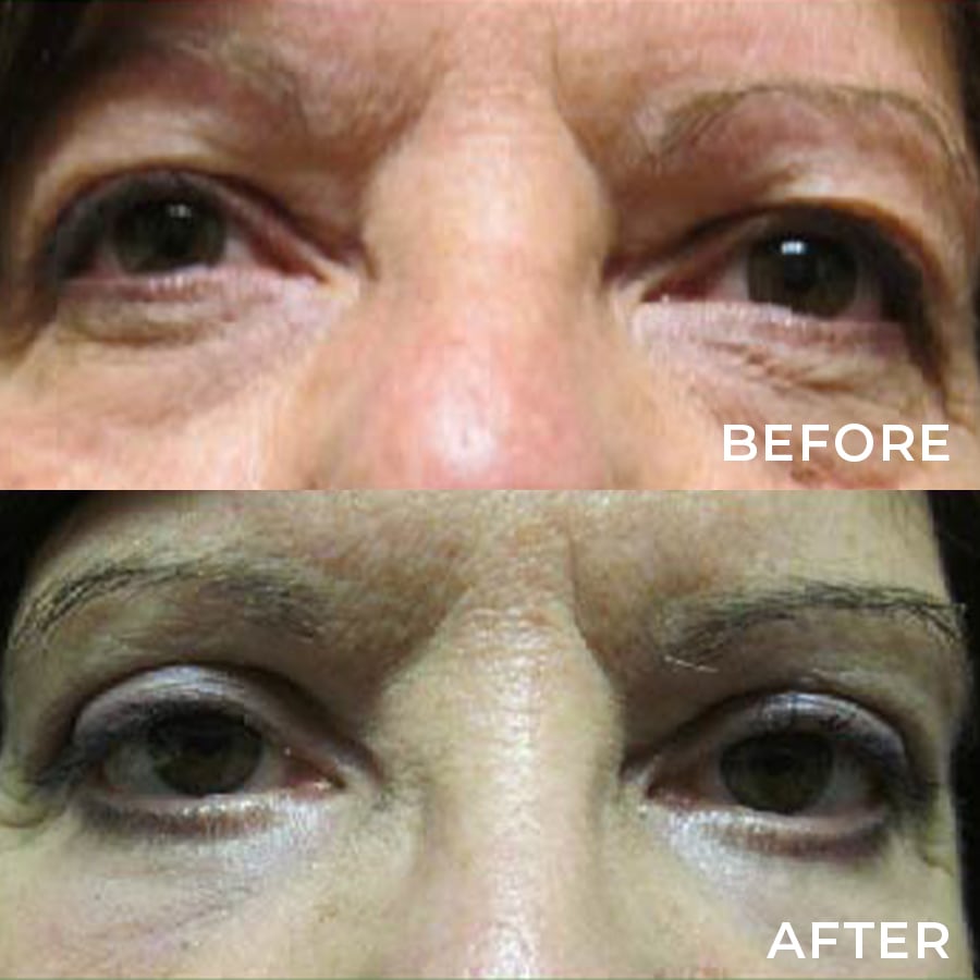 Upper Lid Blepharoplasty & Cosmetic Lower Lid Blepharoplasty with CO2