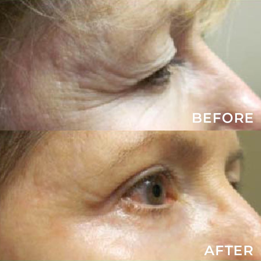 Upper Lid Blepharoplasty and Cosmetic Lower Lid Blepharoplasty with CO2