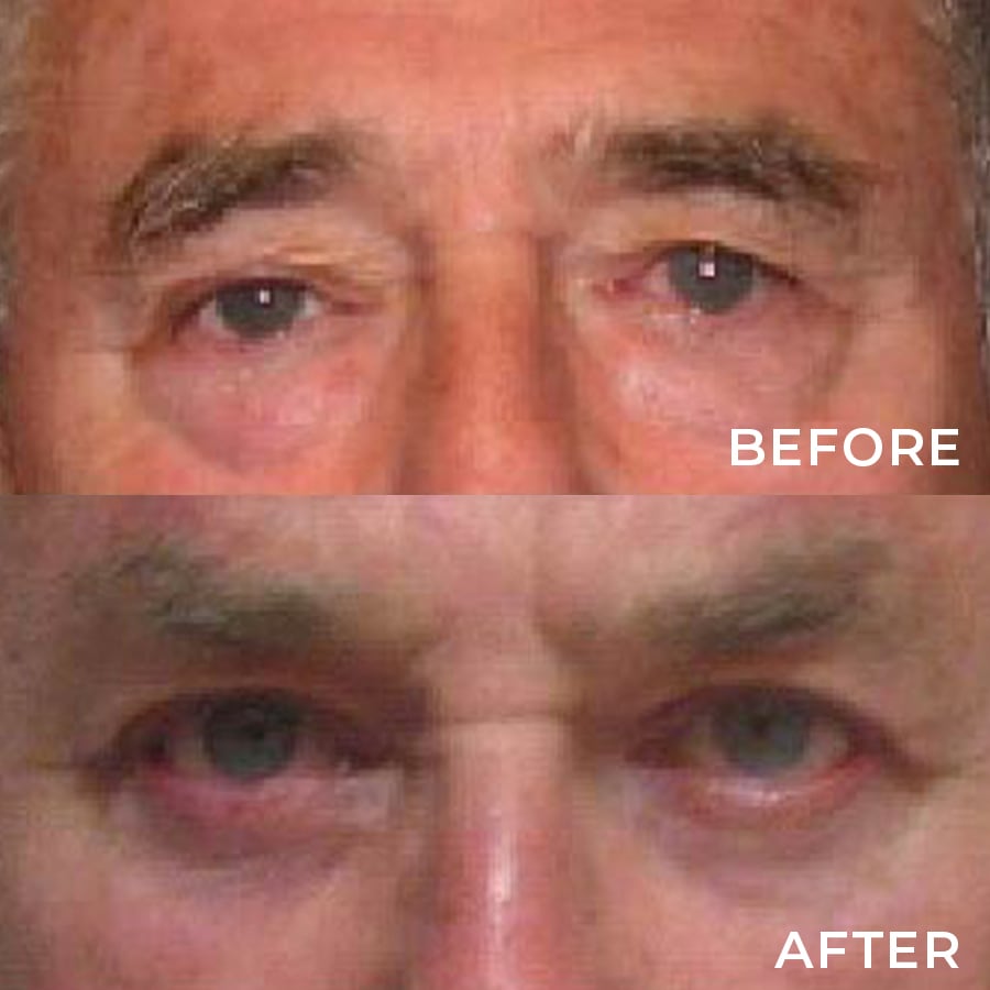 Right Side Levator Advancement with Upper Lid Blepharoplasty, Both Eyes