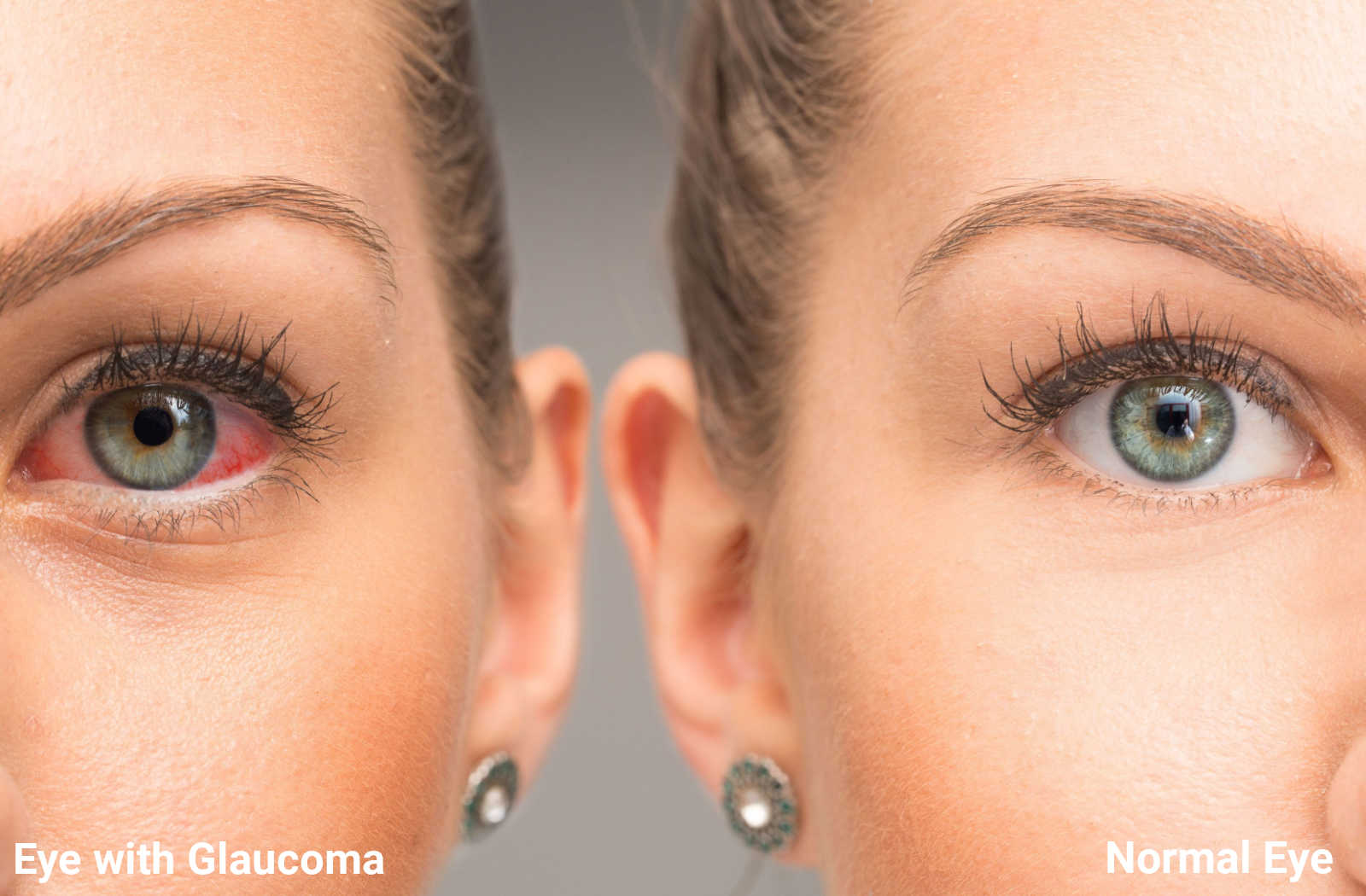 A comparison of a female with normal eye against eye with glaucoma.