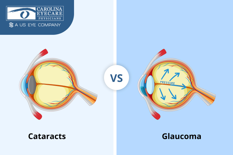 Cataracts vs glaucoma eye comparison