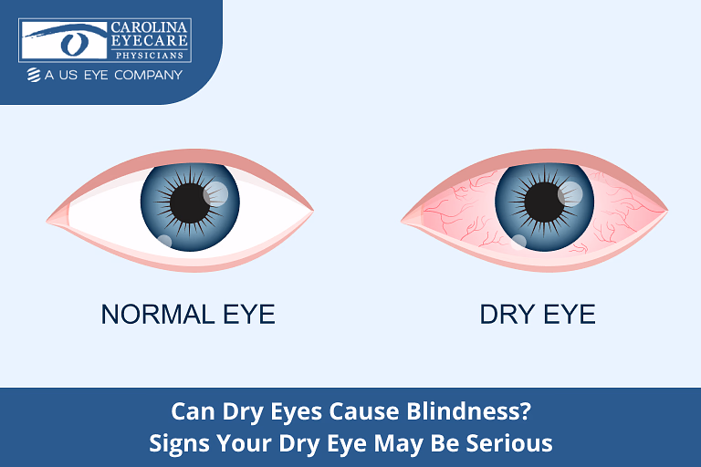 Illustration comparing a normal eye vs. a red, irritated dry eye — Carolina Eyecare Physicians.