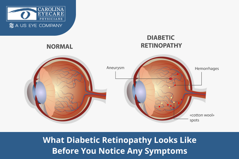 Medical illustration comparing a normal retina with diabetic retinopathy, showing retinal aneurysms, hemorrhages, and cotton-wool spots.